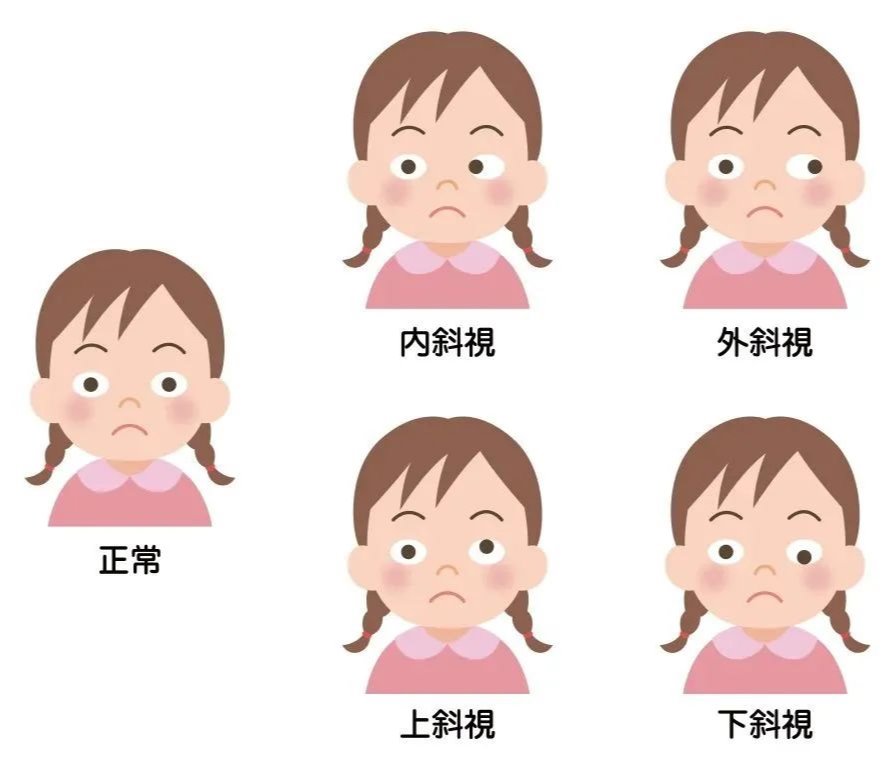 歪头眯眼非小事！斜视正在伤害娃！